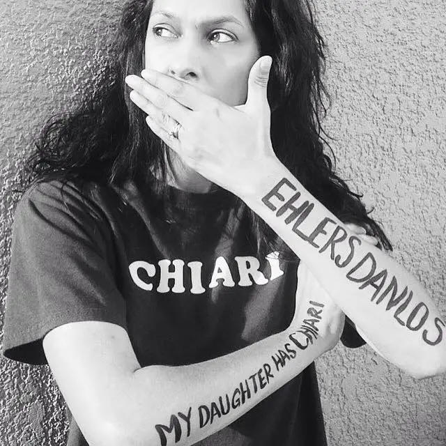 The Chiari Malformation Ehlers-Danlos Connection