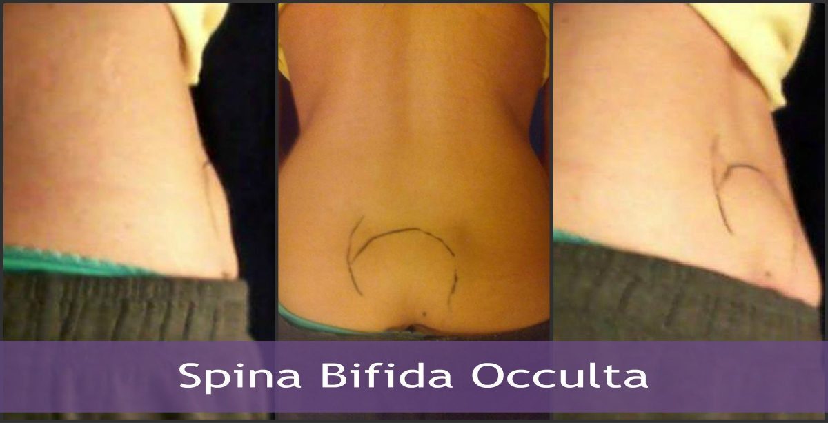 Spina Bifida Occulta