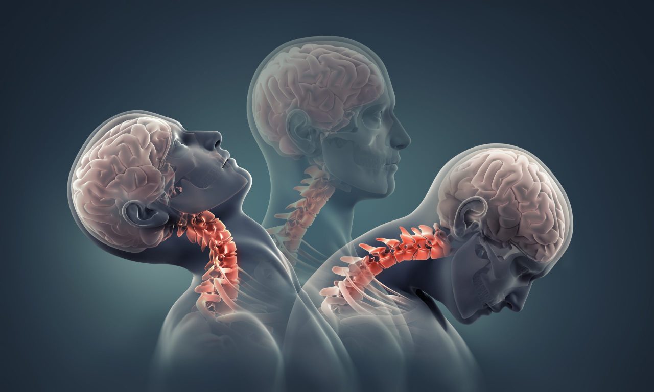 Overview: Craniocervical Instability and Related Disorders