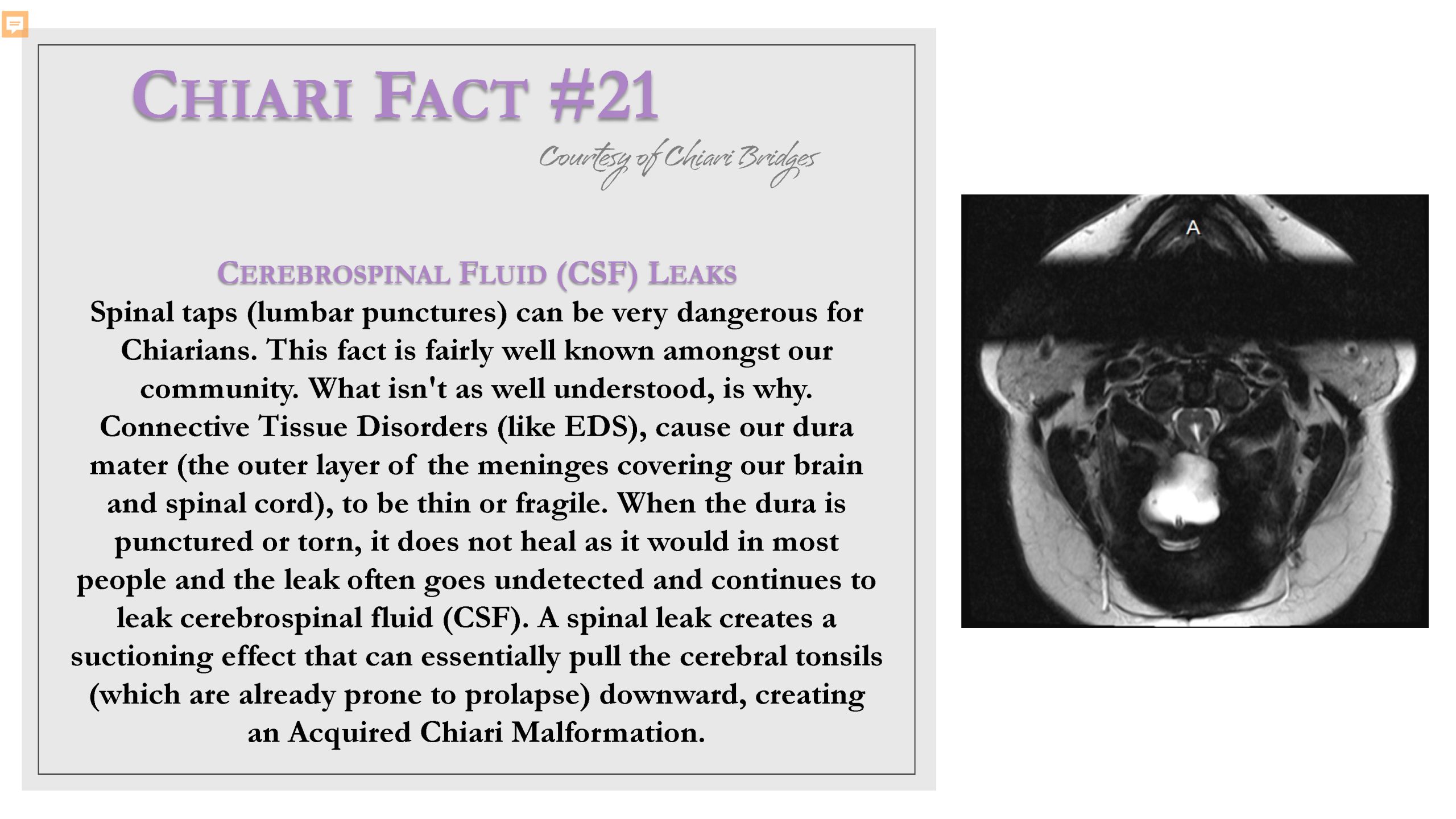Chiari Fact #21