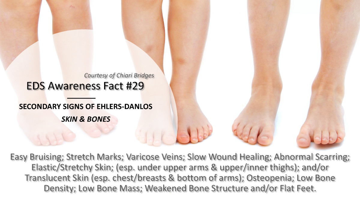 Ehlers Danlos Awareness Month 2025